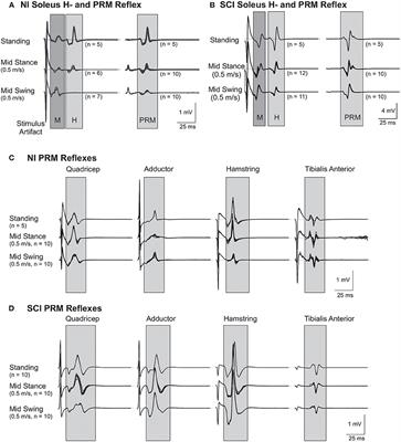 Soleus H and Lower Limb Posterior Root Muscle Reflexes During Stepping After Incomplete SCI